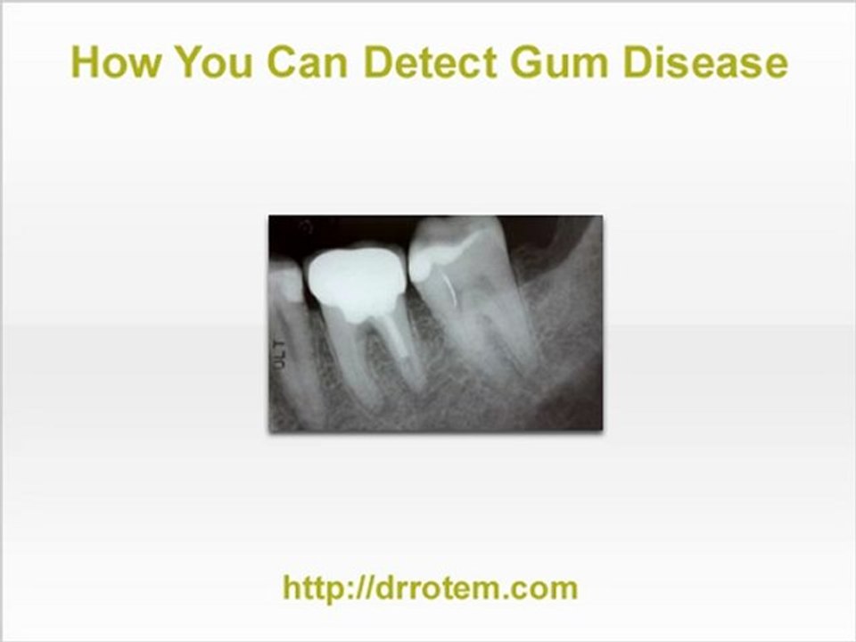 A NJ Dentist on How You Can Detect Gum Disease