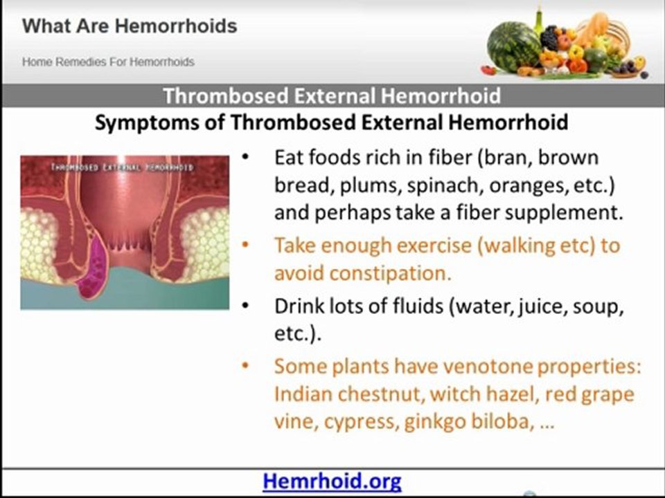 Thrombosed External Hemorrhoid video Dailymotion