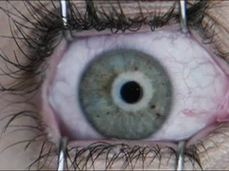 Final Destination 5 - Clip - Laser Eye Surgery
