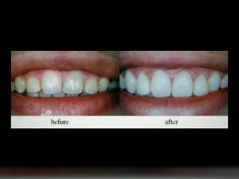 Dental Implants Las Vegas