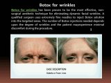 Botox for migraines