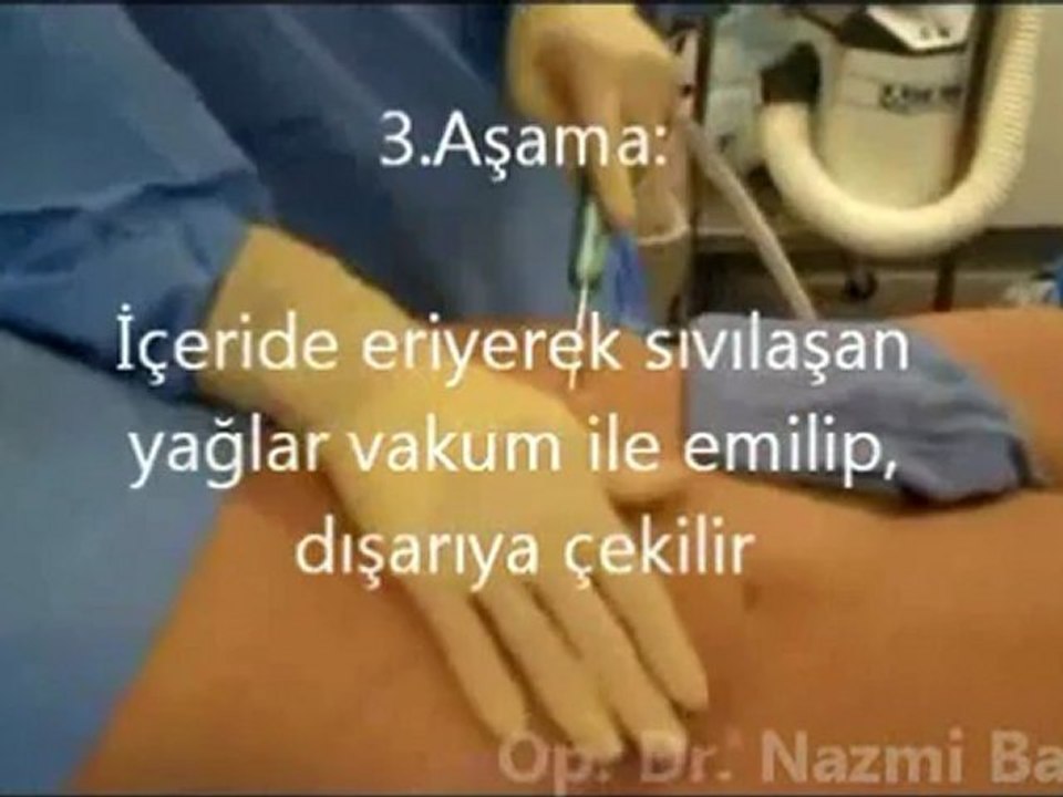 Lazer lipoliz video görüntüleri, Dr. Nazmi Bayçın