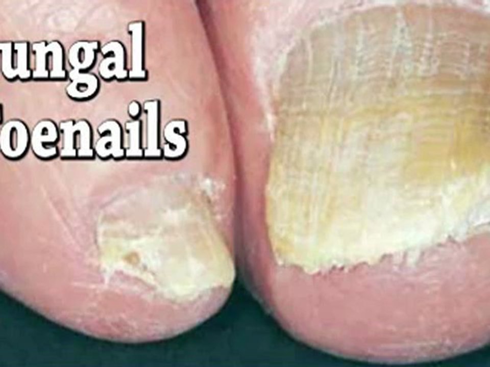 Laser Treatment Fungal Toenails - Fairfield CT, Roslyn and Huntington NY Podiatrist