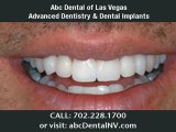 Leaders In Dental Free Implant Treatment. Affordable Dental Implant Center Las Vegas.