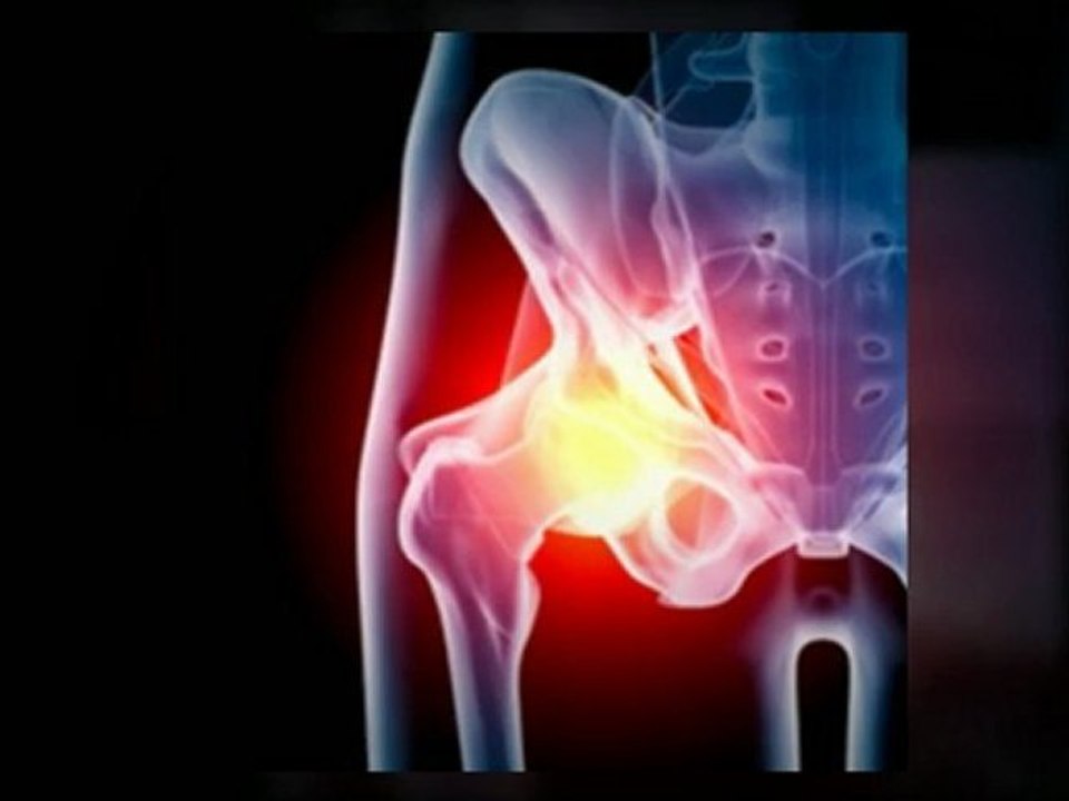 Are You included in the Depuy Hip Recall Class Action?