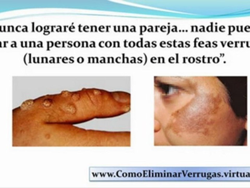 como eliminar verrugas - verrugas en la piel - verrugas en las manos