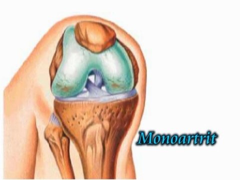 CAMARA HIPERBARICA PERU. Lesiones articulares 2. Lesion de rodilla
