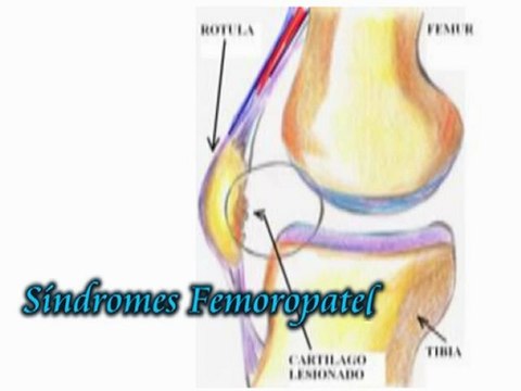 CAMARA HIPERBARICA LIMA PERU. Lesiones Periarticulares. Lesión en rodilla.