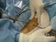 traitement chirurgical mini invasif de la tendinite du tendon rotulien