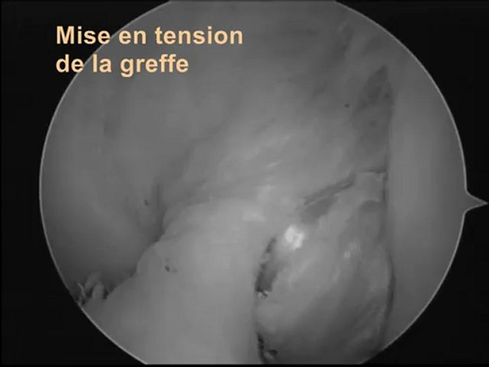 Rupture partielle du ligament croisé anterieur rupture du faisceau pl