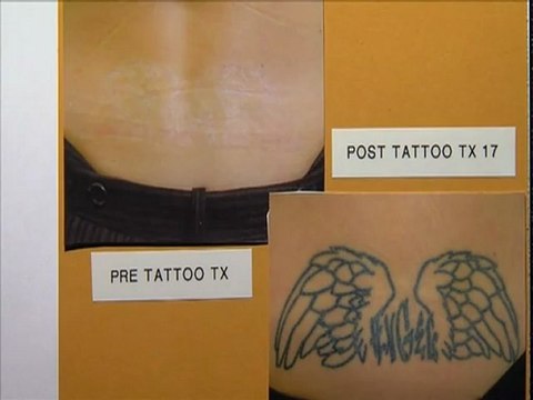 Dr. Eric Seiger: Tattoo Removal Laser