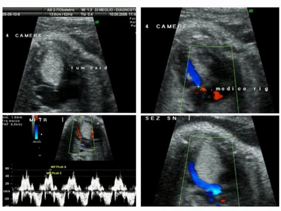 Tumore cardiaco