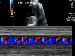 Aritmia nel secondo trimestre