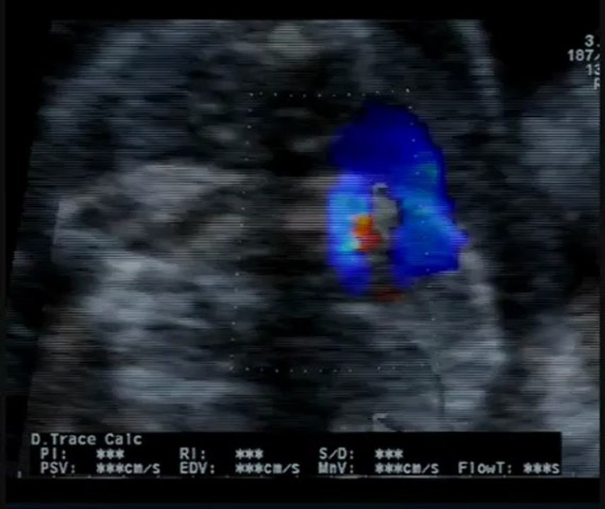 Sindrome cardiosplenica
