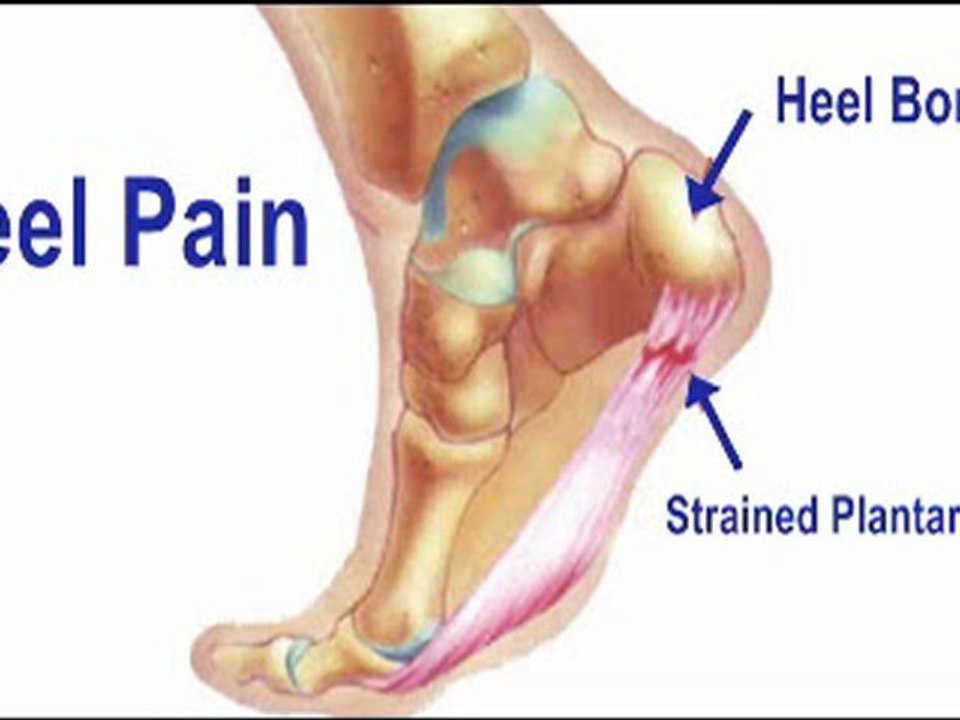 Heel Pain - Podiatrist in Clark, NJ - Clark Podiatry Center