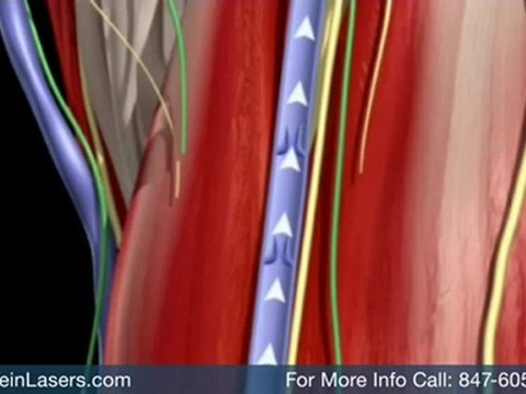 varicose vein treatment Barrington vein removal - Laser Vein Treatment