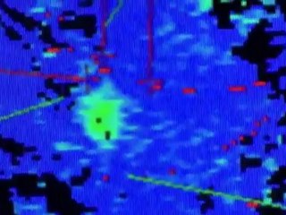 Looking for Prostate HIFU Procedure doctor's