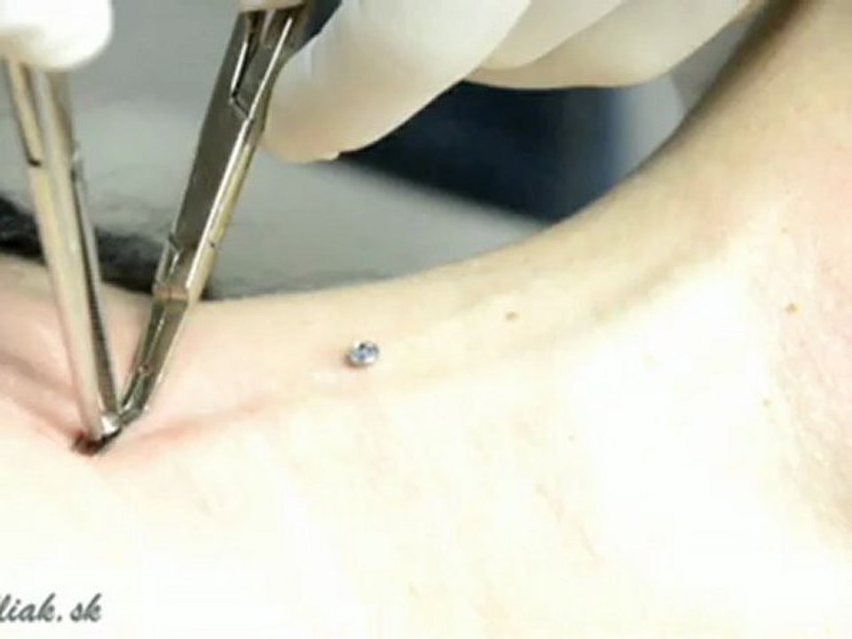 Microdermal
