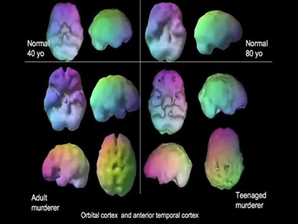 Vitamins for memory-Jim Fallon-Part1
