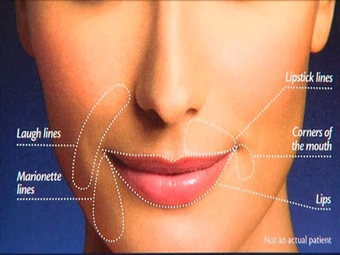 Dr. Eric Seiger: Restylane Injections
