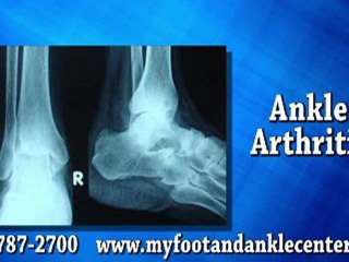 Ankle Arthritis - Podiatrist in Springfield, IL