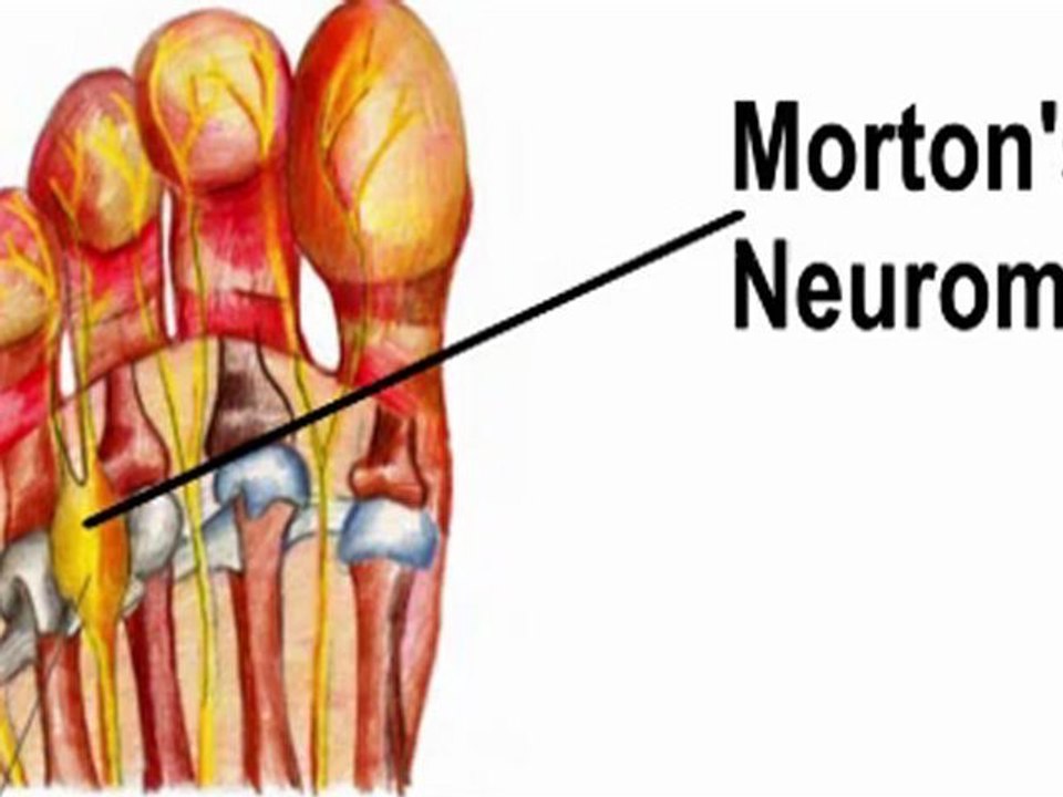 Morton's Neuroma -  Podiatrist - Kansas City, MO - Overland Park, KS