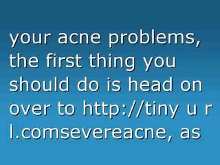 Getting Rid of Acne for Good