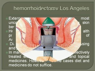 BENEFITS OF HEMORRHOID SURGERY