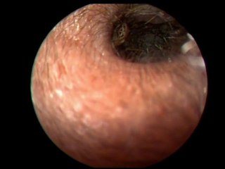 Un insecte dans l'oreille