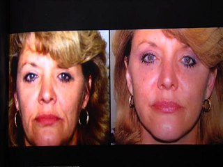 Dr. Eric Seiger: Lunch Hour Face Lift
