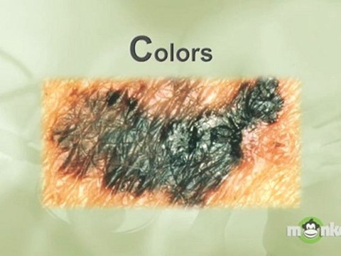 Skin Cancer Detection & Prevention Tips