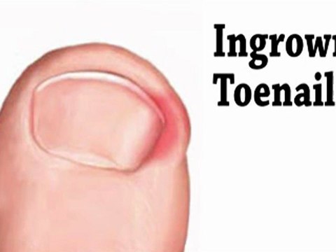 Ingrown Toenail - Chicago, Six Corners, Northwest Side - Podiatrist - Marc Feder, DPM
