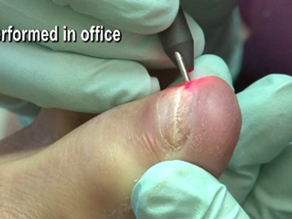 Laser Fungal Toenails - Chicago, Six Corners, Northwest Side Podiatrists