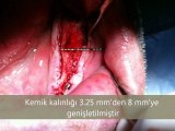 İmplant Diş Tedavisi ; Alt çenede ince kemiğe implant ameliyatı , implant  video , implant diş ameliyatı izle