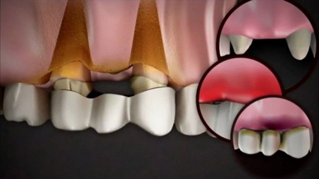 Neden implant yaptırmalıyız ? implant tedavisi , implant videoları , implant diş ameliyatı , MUSTAFA GÜVEN , implant yapımı