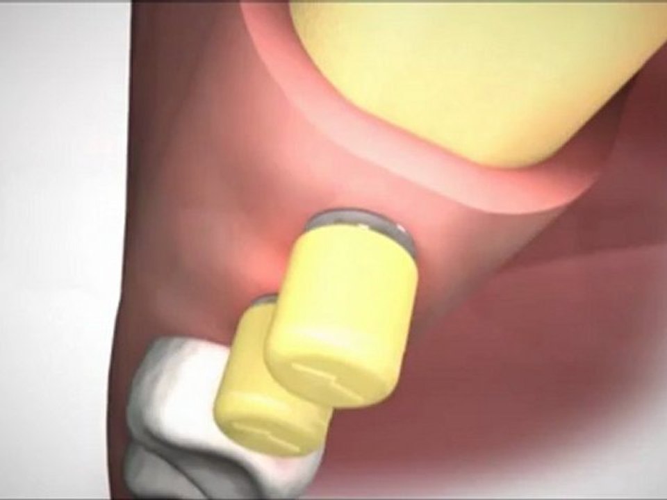 İMPLANT  TEDAVİSİ  Mİ  ?  DİŞ  KÖPRÜ  TEDAVİSİ Mİ ?  implant diş videoları izle