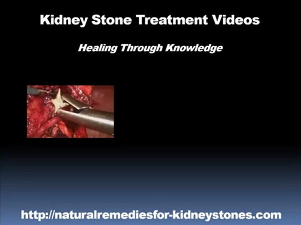 Natural Remedies For Kidney Stones