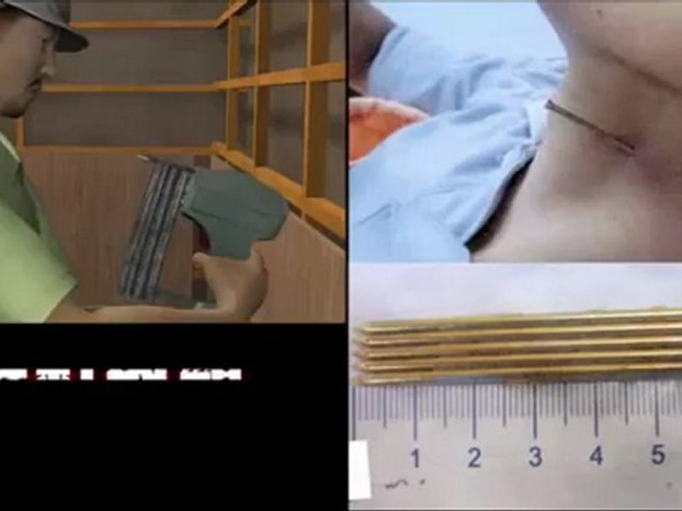 Miracle! Man survives one in a million nail gun neck shot