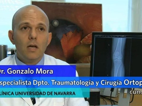 Salud: Células madre de la médula ósea para el tratamiento de la artrosis de rodilla