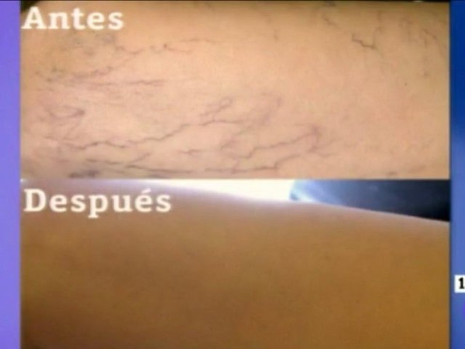 Eliminar varices, telangiectasias, arañas vasculares