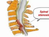 sciatica pain reliever - how to relieve pain from sciatica - sciatica pain in leg