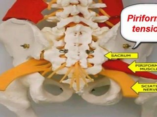 what are the symptoms of sciatica - what is sciatica symptoms