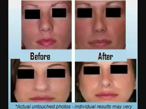 Nose Job Alternative- Nose Huggie - Get a smaller nose in 2 weeks