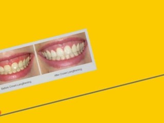 Laser Gum Therapy Seattle