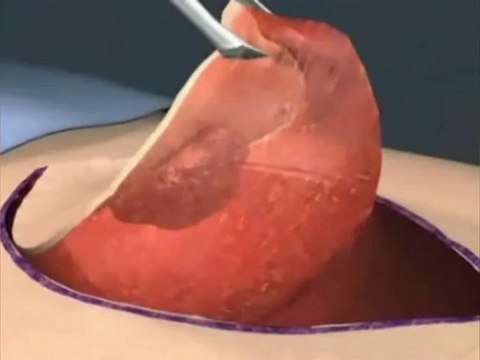 Melanoma the Skin Cancer - How the Cancer Develops