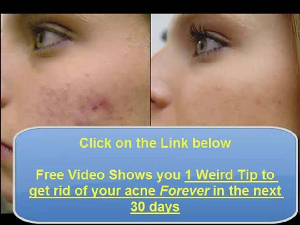 Natural Acne for Cures Acne Home Remedies