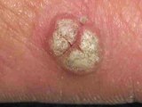 Foot Warts (Plantar Warts) NYC Podiatrist Lower Manhattan