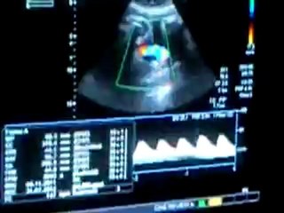 Echographie de 3eme trimestre.