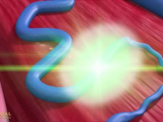 ESCLEROSIS Y TÉCNICA LÁSER DE VARICES