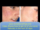 Acne Scaring cures Acne scar home remedies Secrets Revealed!